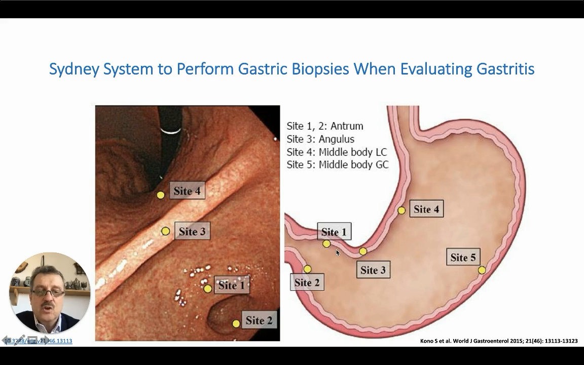 EndoCollabcom's tweet photo. Sydney Protocol for Stomach Biopsies

Are your gastritis biopsies missing cancer risk?

The Sydney Protocol's 5-site systematic sampling captures the multifocal nature of H. pylori disease that random biopsies miss.

✅ Contralateral antral + body sampling  
✅ Don't forget incisura angularis
✅ "More is better" - we take 6, not 5

Watch: https://t.co/8nRU19hddc Protocol Stomach Biopsies-00-01-51-667.jpg