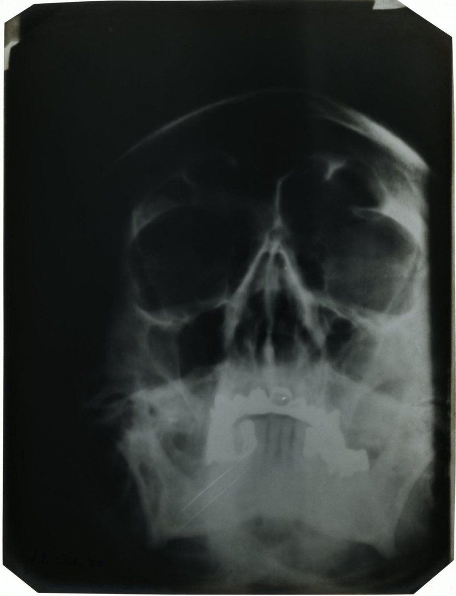 figamak's tweet photo. @JonDoe279718 @wh0_0uyM @austinwarner155 @DarkOddCon They literally found his jaw, and it matches the 1944 X-ray. Cope harder https://t.co/t5D5XbdxFy