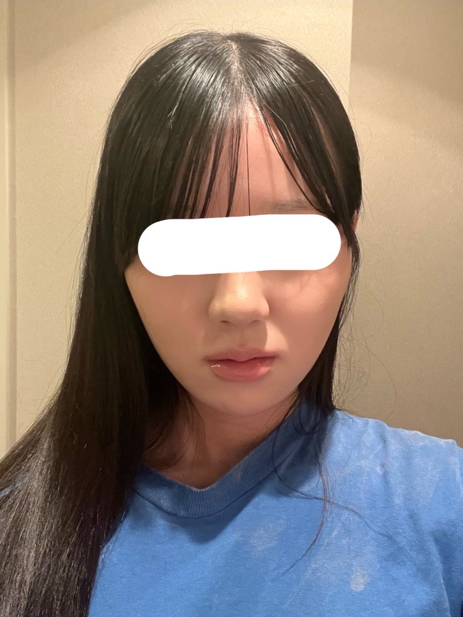 6gC21's tweet photo. 糸リフト後に脂肪吸引した方いらっしゃいましたらお話お伺いしたいです🙇‍♂️
(どれくらい期間開けたか等)

脂肪吸引のリスクにﾋﾞﾋﾞｯて糸リフトだけしたけど、糸リフトの継続期間の短さを懸念するとやっぱり脂肪吸引も同時にすればよかったと後悔中(>_<)

⬅️before
                  after➡️ https://t.co/CoShj0tEHS