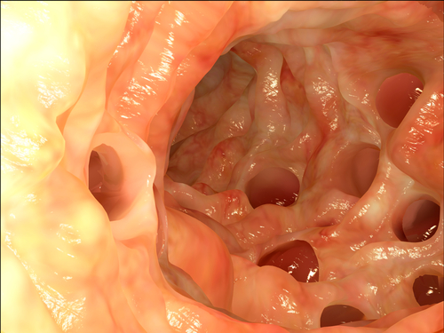 r0iluminado's tweet photo. #digestivoR0 DiverTRIculitis:
Absceso de más de 3 cm = DRENAJE
Estadíos mayores a 3 = Cirugía
(La presencia de peritonitis indica estadio 3 o 4 y portanto cirugía).
#MIR27 https://t.co/3fdlGT4tEc