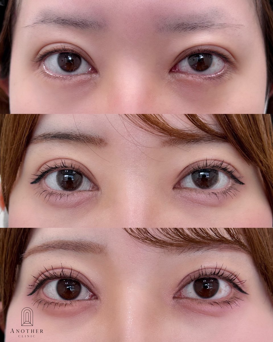 biyou_keinsym's tweet photo. 【外科的涙袋形成の1〜2ヶ月後】

涙袋の要素は２つに分かれます
①volume要素(ヒアル、脂肪、真皮移植)
②くびれ要素(靭帯)

②が無いのに①をやっても出にくいし、
②だけやっても①の要素がないとぷっくり膨らみません

例えばこの症例の方は②だけやっているので、膨らみはかなり自然な状態になっています☺︎