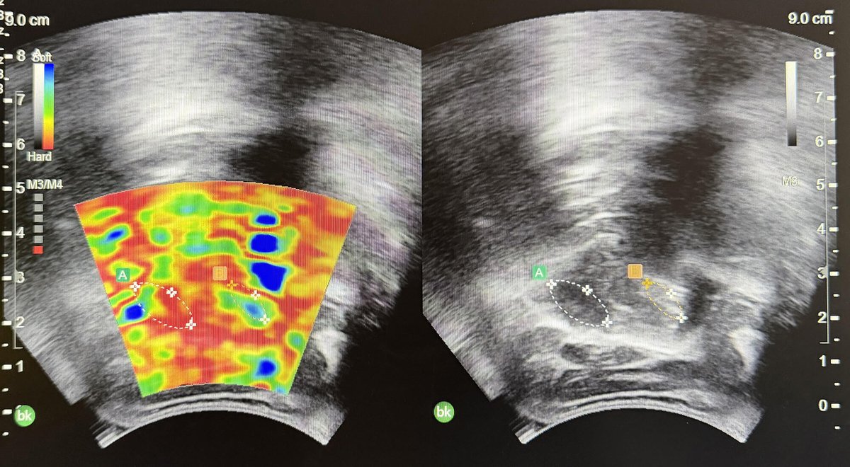 CEOGjournal's tweet photo. 💡Could #Elastography reveal the hidden #OASIS that standard #Ultrasound misses after childbirth? #ObGyn #PelvicFloor #WomensHealth
👉: https://t.co/JdxwOMc6gk
#MaternalHealth #Obstetrics #ShearWaveElastography #ChildbirthInjury https://t.co/Iv7jlffHYs