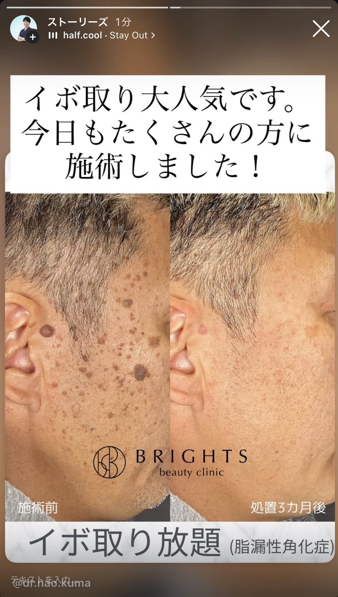 naoki_imamura's tweet photo. 多発する脂漏性角化症を液体窒素で取るのは、ムリだと思ってください。

電メスかCO2レーザーの２択です。 https://t.co/zPWZBYXrJJ