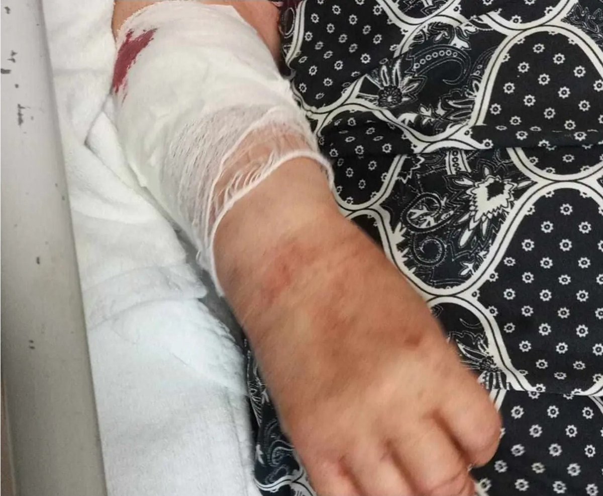 GusoderX's tweet photo. 🔴 SON DAKİKA | Çankırı'nın Ilgaz ilçesine bağlı Cömert köyünde başıboş köpek saldırısına uğrayan kadın yaralandı.

Kolundan ısırılan ve omzu çıkan kadın, köylüler tarafından kurtarılarak hastaneye götürüldü.

ℹ️ BİLGİ: Köylerdeki başıboş köpekleri toplama görevi 5199 sayılı Kanun gereği İl Özel İdaresi'nin sorumluluğundadır.

ℹ️ Valiliklerimiz başıboş köpekler konusunda muhtarları bilgilendirmeli, köylerde tespit edilen başıboş köpekler ivedilikle toplanmalıdır.

Çankırı Valimiz Sayın Hüseyin Çakırtaş (@hcakirtas58), köylerdeki sahipsiz başıboş köpeklerin ivedilikle toplanmasını, saldırıya karışan köpeğin sahipli olması durumunda ise mevzuat gereği köpeğe el konularak sahibi hakkında adli ve idari işlem yapılmasını talep ediyoruz.

@CankiriValiligi @mustafaciftcitr