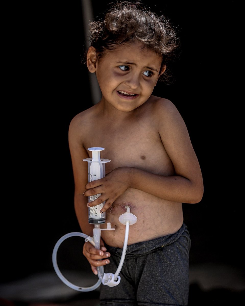 EyeonPalestine's tweet photo. Urgent Appeal to Save the Life of Najwa Haggag
We appeal to the World Health Organization (WHO) to intervene immediately to secure an urgent medical evacuation for 7-year-old Najwa Haggag. She suffers from severe esophageal stricture and weighs only 9 kg (approximately 19.8 lbs). Her condition is critical after being forced to return before completing her vital surgery.
To contact the family:
+972 59-918-0238

نداء استغاثة عاجل لإنقاذ حياة الطفلة نجوى حجاج
نناشد منظمة الصحة العالمية للتدخل الفوري لتأمين إجلاء طبي عاجل للطفلة نجوى حجاج (7 سنوات). تعاني الطفلة من تضيق شديد في المريء وتزن 9 كجم فقط، وحالتها حرجة للغاية بعد إجبارها على العودة دون إكمال علاجها الضروري.
للتواصل مع العائلة:
972599180238+