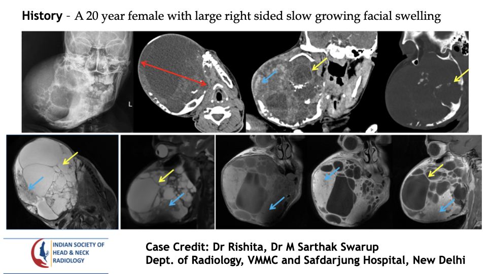 teamishnr's tweet photo. #caseoftheweekanswer

Please find the answer
#radiology #caseoftheweek #headandneck #radiologycases #dailywork #ISHNR #teaching #research #imaging #FOAM #FOAMRad #FOAMMed

Visit our website: https://t.co/rgh521JNBP
All Cases: https://t.co/0xaPvoBy5H https://t.co/y7vpMX6Uz8