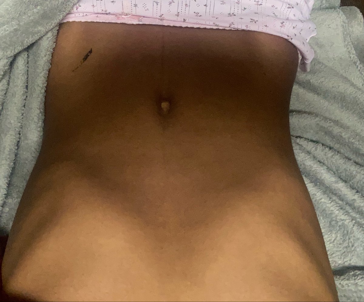 heyhowsitgoing's tweet photo. i just wanna be at 90lb but i’m in 100 jail #edtwtㅤ #shtwt  also the black is a temp tattoo DONT REPORT JUST BLOCK!!! FAKE BODY AI SLOP https://t.co/BkLpq3MnF7