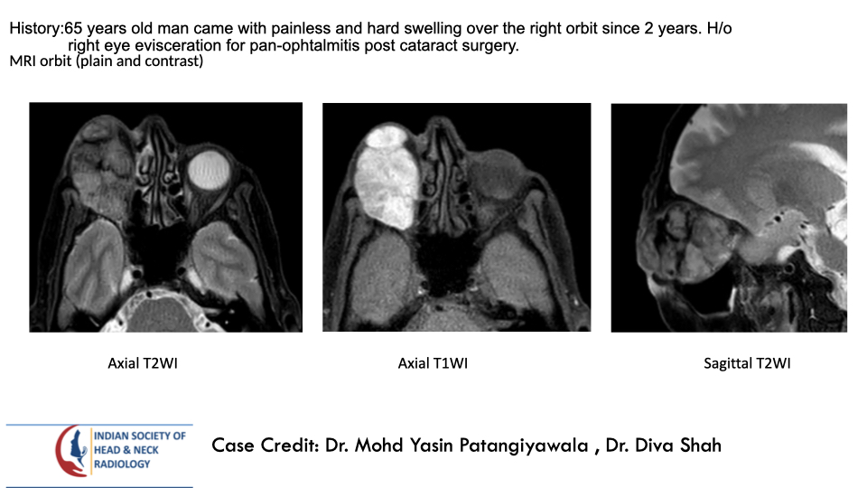 teamishnr's tweet photo. #caseoftheweek
What are the findings and DDx?
The answer will be uploaded tomorrow
#radiology #caseoftheweek #headandneck #radiologycases #dailywork #ISHNR #teaching #research #imaging #FOAM #FOAMRad #FOAMed
Visit our website: https://t.co/9KlZmntJ98 https://t.co/WsLUbJOIln