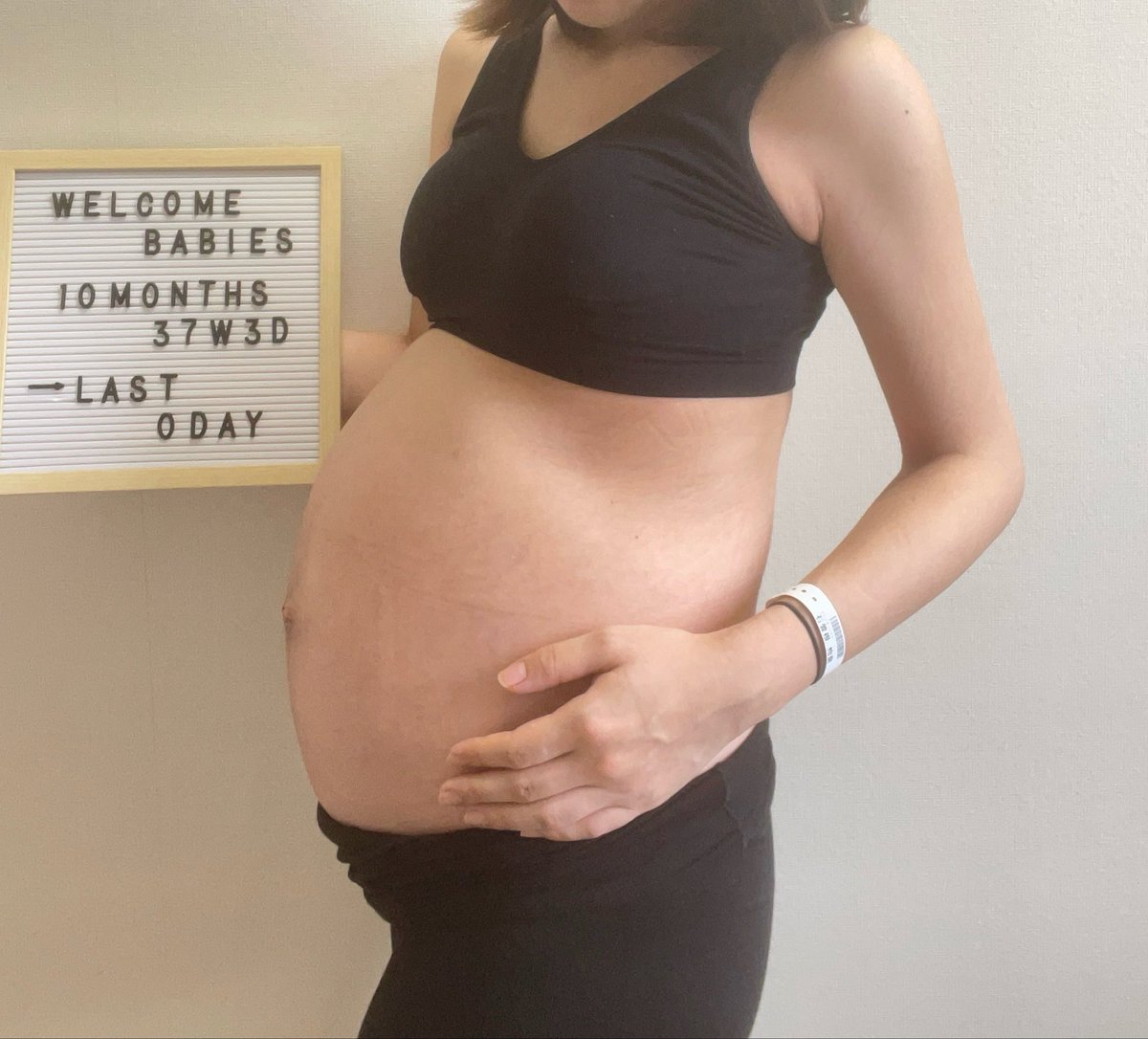 zonekomata's tweet photo. マグセントきっかけで双子妊娠の時のいろいろ見返してた
双子妊娠時の帝王切開当日のお腹
前に出ず上と背中に出てたタイプだったな
※お腹の写真だよ https://t.co/xyEAoTLHQN