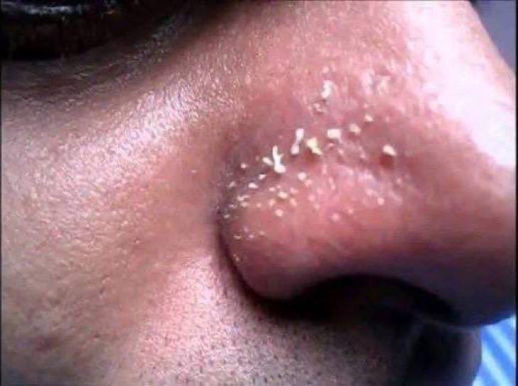 Laineytales's tweet photo. Hey @grok I keep getting this white stuff on my nose. 
What’s the cause and how can I get rid of it? https://t.co/skH5ylM5o5