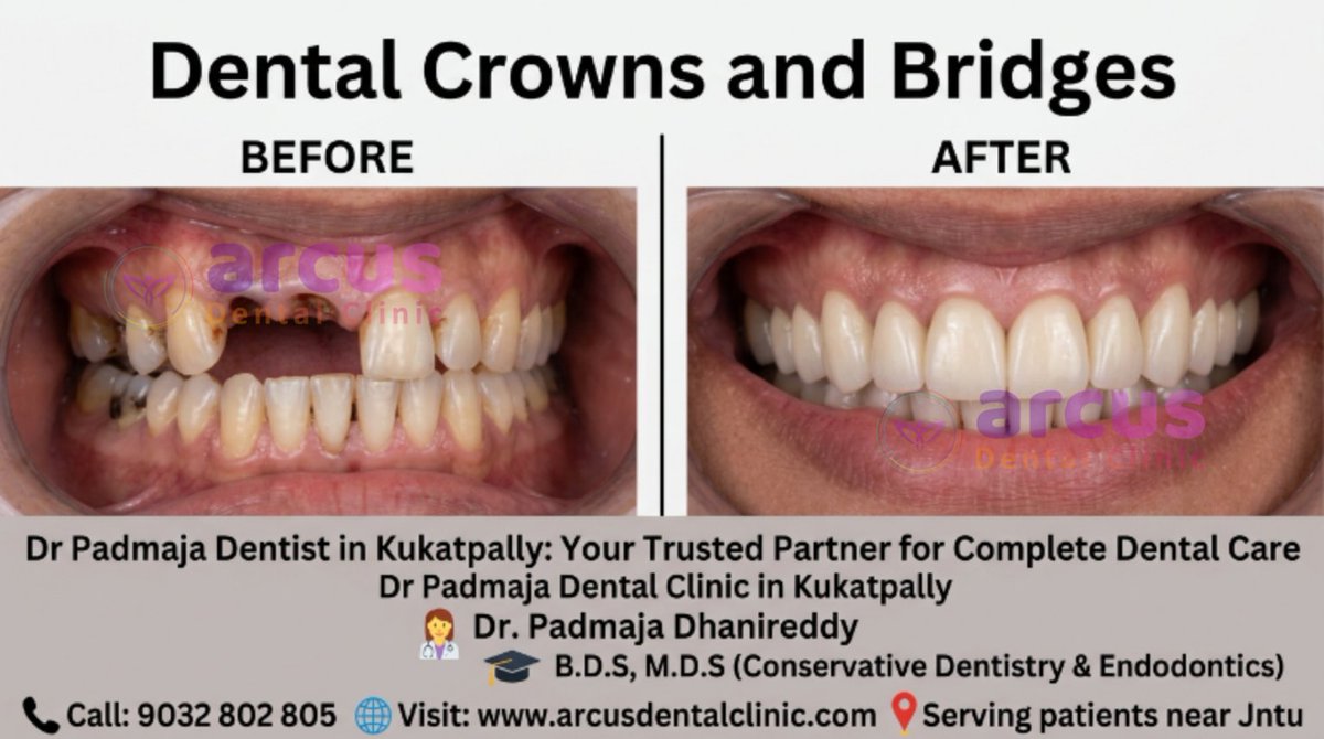 Arcus_Clinic's tweet photo. Rating: 4.9 ⭐⭐⭐⭐⭐
🦷✨ Dr. Padmaja – Trusted Dentist in Kukatpally ✨
👩‍⚕️ Dr. Padmaja Dhanireddy
🎓 B.D.S, M.D.S
📞 Call: 9032 802 805
🌐 Visit: https://t.co/xEUb1y6DPn
📍Serving patients near Jntu
#ToothExtraction #DentalCare #OralHealth #Dentist
#DentalTreatment https://t.co/6A3J0lcd1L