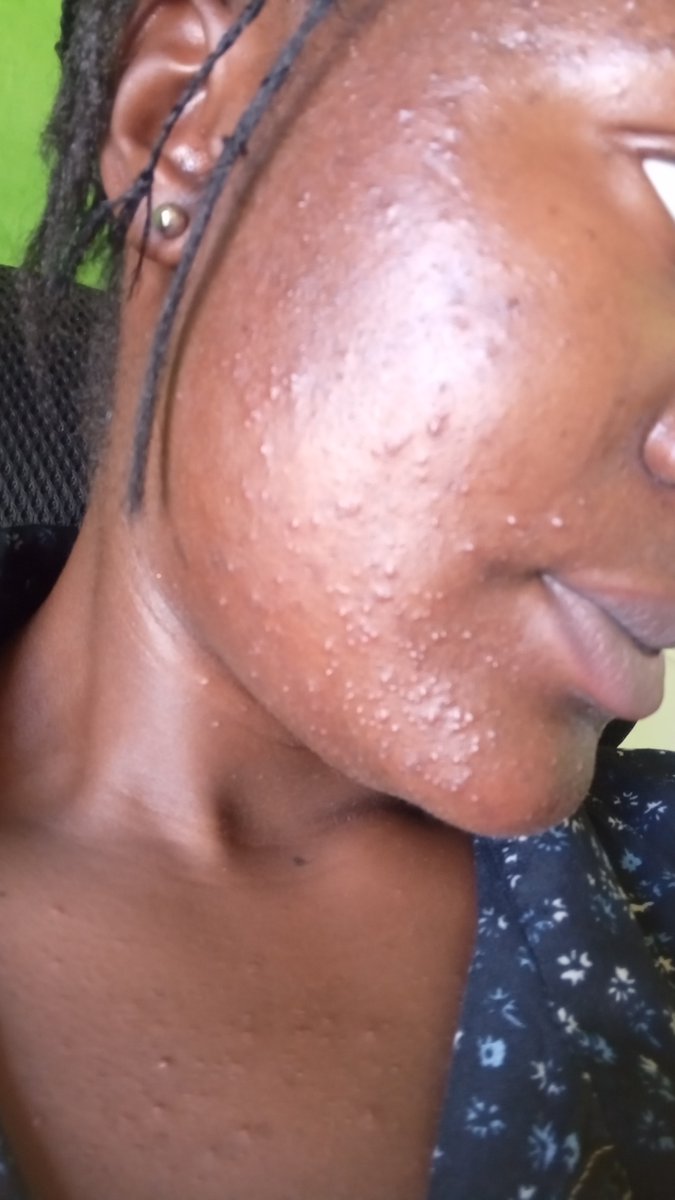 Barmani96's tweet photo. Helloooo, get down!
If my skin later clear like her own I go say na my achievement.
If Acne never deal with you before uno go understand. https://t.co/bgQNEtRjNO