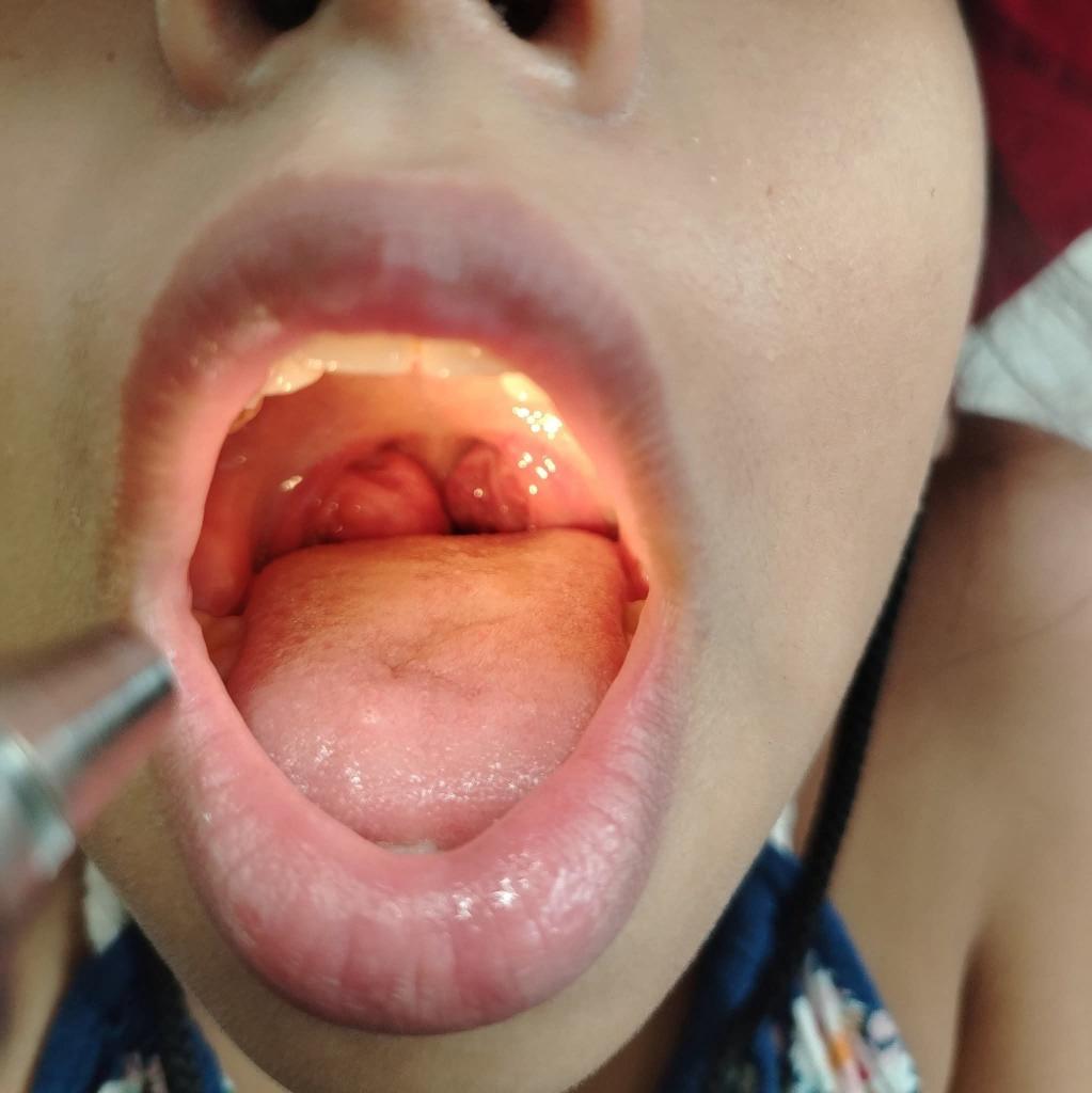 ElPaido's tweet photo. No todo niño con dificultades de atención tiene TDAH. Niña de 10 años referida por probable TDAH por rezago escolar, pero la historia reveló respiración oral, ronquidos y en la exploración amígdalas grado IV. La afección a la respiración puede afectar conducta y cognición. https://t.co/GYfPpRgeDV
