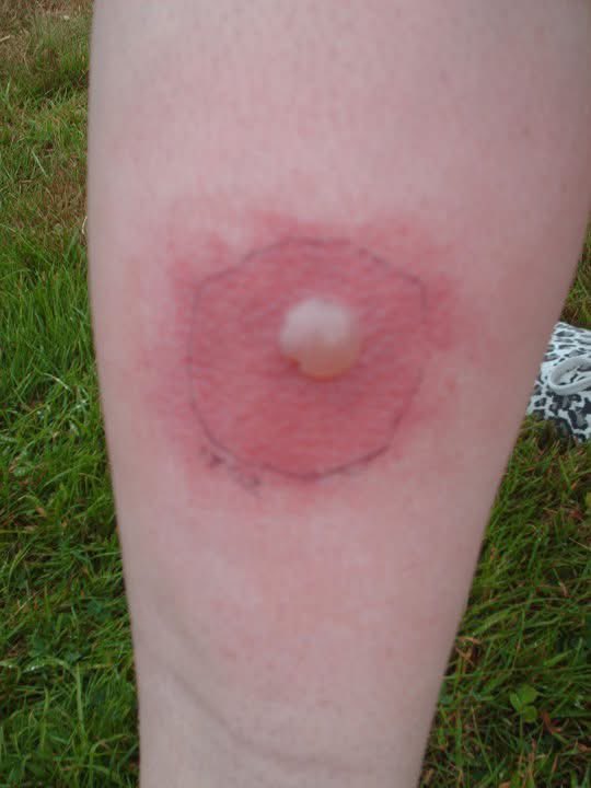 Smandaangel's tweet photo. @AJBthe6th @bushontheradio One of these little fuckers landed me in hospital on IV antibiotics overnight with this beauty of a bite (had two more circles round it in the end) then enough oral antibiotics for another week to make me rattle 🙈 
 Now have a very similar reaction to any fly bite 🥺🥺 https://t.co/8kOku8JbWX