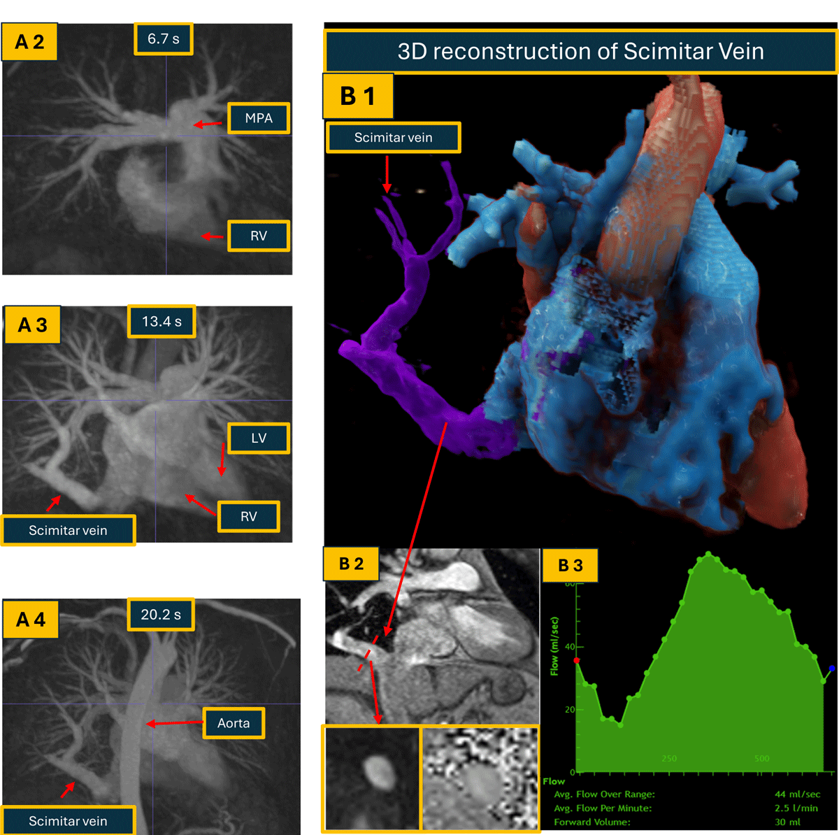 DeBakeyCVedu's tweet photo. ACHD imaging requires technology, specialized training of sonographers/technologists/cardiologists, standard protocols &amp; team care
Initial Diagnostic Approach to ACHD-Practical Imaging Pathway @aliciarangosch @AneeshDhore @valeriaduarteMD #DeBakeyCVJournal https://t.co/5ZKdMZ4uf6 https://t.co/hOYUuqcI2C