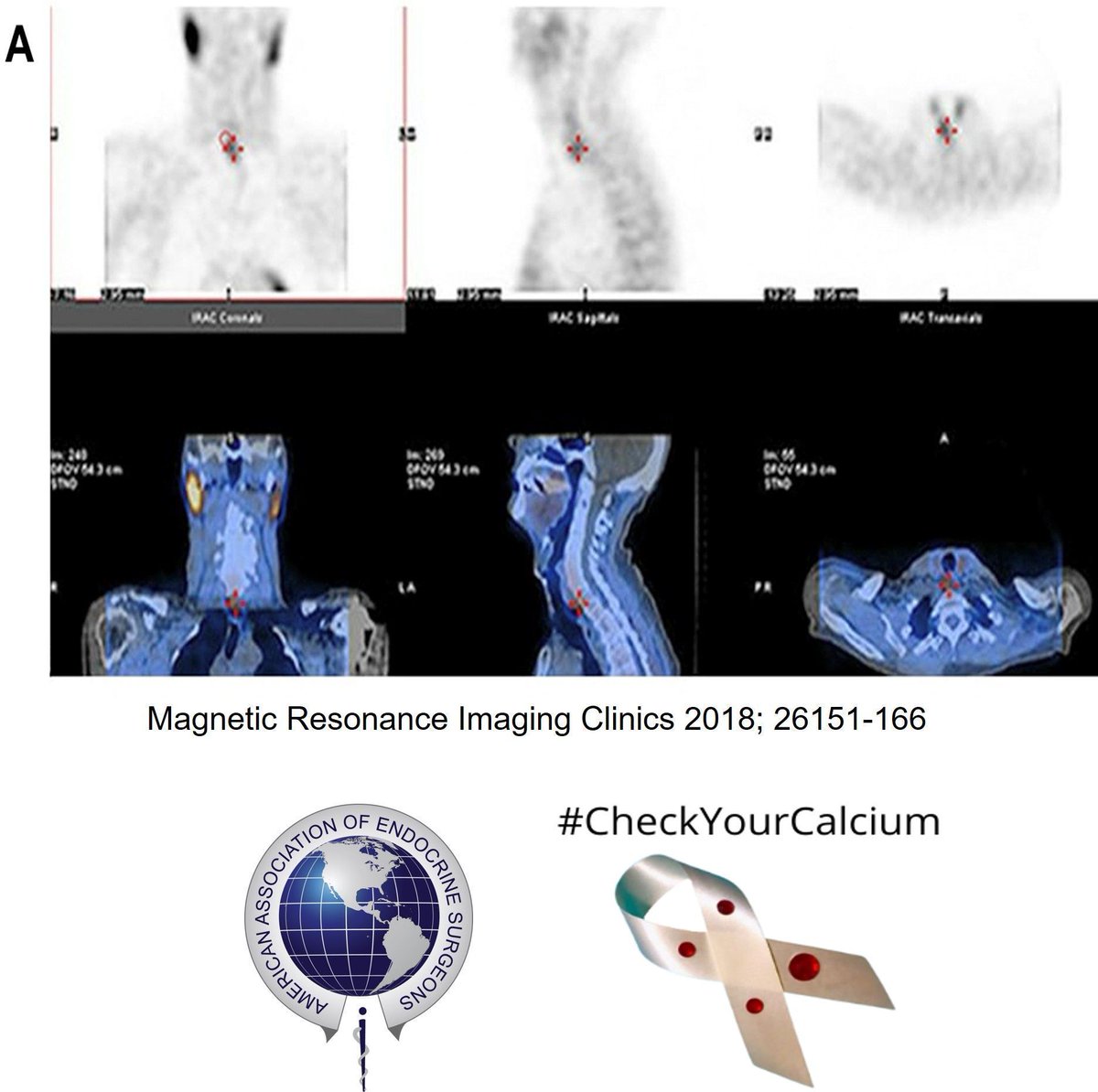 TheAAES's tweet photo. Did your parathyroid scan come back negative? 

Scans can miss small tumors or multiple overactive glands—but that doesn't mean you don’t have primary hyperpara.

✅ An experienced parathyroid surgeon can often find the problem—even when scans don’t. 
 
#PAM2026 @Paratroupers1 https://t.co/zwHn5dLPvU