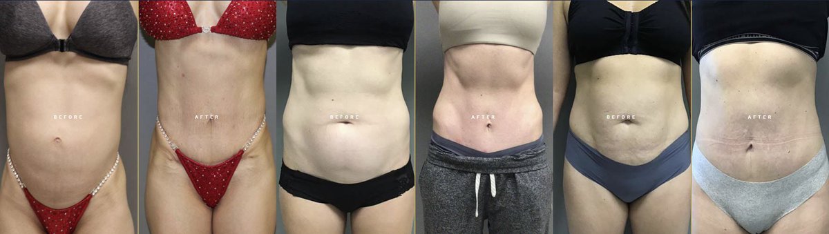 surgicaloasis's tweet photo. Dri-Tuck - One procedure. Two powerful results: a more contoured stomach with a fully restored core — through a smaller, more discreet incision. Learn more about #Dri-Tuck &amp; it's procedures. Call #DrIraniha today. DrIranihaExpertCosmeticSurgery https://t.co/XEsUK9gjbw https://t.co/PUg9Ddge7b