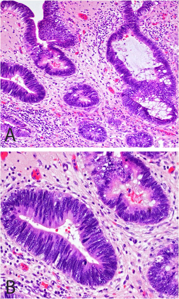 LiangChengMD's tweet photo. Comprehensive review on diagnostic criteria and classification of malignant glandular lesions of the urinary bladder by Dr. Fanni Santa @FV_Santa and her colleagues, published as the featured cover article @Human_Pathology.
 
This review provides a practical framework for one of the most diagnostically challenging areas in genitourinary pathology, integrating contemporary morphologic, immunohistochemical, and molecular advances into a unified diagnostic approach.
 
Dr. Fanni Santa and her colleagues address the classification and differential diagnosis of primary bladder adenocarcinoma, urachal adenocarcinoma, Müllerian-derived tumors, and precursor lesions, emphasizing key diagnostic pitfalls in distinguishing these uncommon neoplasms from more common primary bladder tumors and secondary involvement by tumors from other organs. The review also highlights emerging molecular insights, including recurrent genomic alterations with potential therapeutic implications, and discusses evolving concepts surrounding precursor lesions such as villous adenoma, cystitis glandularis with intestinal metaplasia, and adenocarcinoma in situ.
 
This comprehensive review is an essential resource for pathologists, urologists, oncologists, and trainees, and hope it will contribute to improved diagnostic accuracy, multidisciplinary communication, and optimal patient management for these rare but clinically significant tumors.

Read the full article here:
https://t.co/hHpwZz0VKM