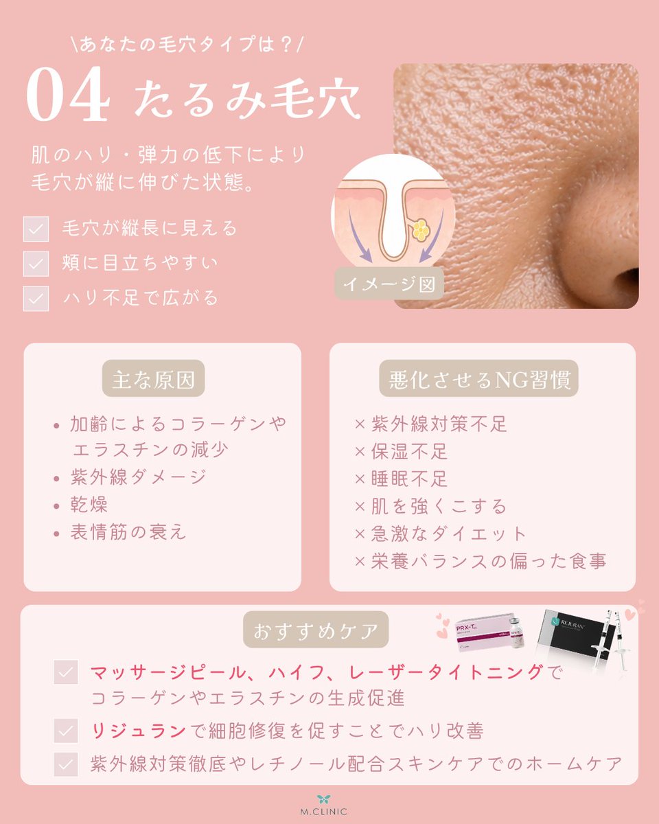 mcli_official's tweet photo. 【保存推奨】毛穴悩みは、実はタイプによって原因もケア方法も違います💡

✔ 開き毛穴
✔ 黒ずみ毛穴
✔ 詰まり毛穴
✔ たるみ毛穴

あなたはどのタイプ？

今回は、それぞれの特徴とおすすめのケア方法をまとめました✨
ぜひ最後までチェックしてみてください😊

#美容皮膚科 #スキンケア #美容医療 https://t.co/V0zbJuE0DR