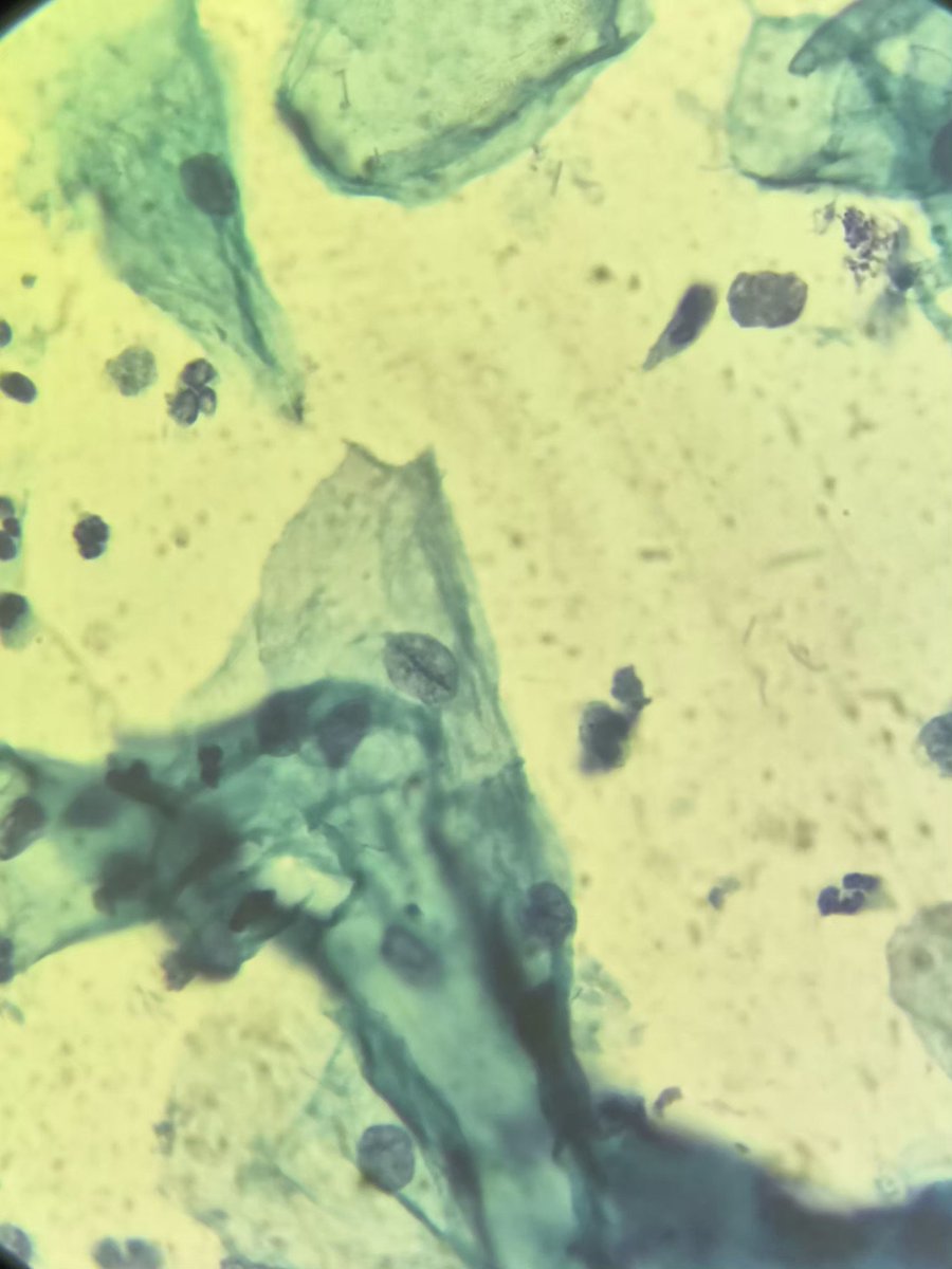 DrIndhug's tweet photo. Cytology Quiz

37 year old woman with brownish vaginal discharge.
Pap smear shows numerous pear shaped flagellated organisms with a background of inflammation.
Whats your diagnosis?
1. Bacterial vaginosis
2. Candidiasis
3. Trichomoniasis
4. Atrophic vaginitis
#Cytology#MedTwitter https://t.co/PeLr6yHNzL