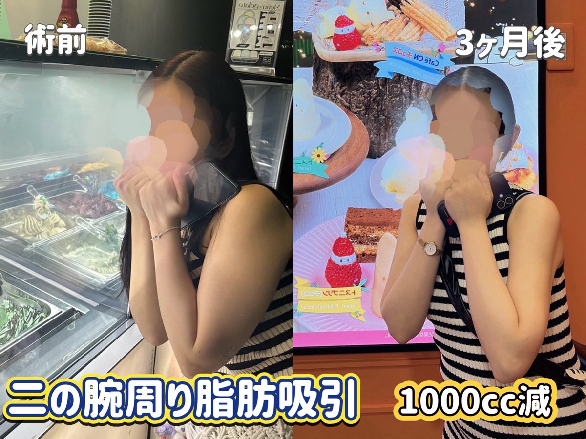 dr_gibo_'s tweet photo. 【二の腕パーフェクト仕上げ】

二の腕をスッキリさせてから、ノースリーブをたくさん着るようになったそう👗

二の腕は上半身の華奢感に直結しますし、自信を持って出せるようになってもらって嬉しい限りです😆 https://t.co/gnP39X660m