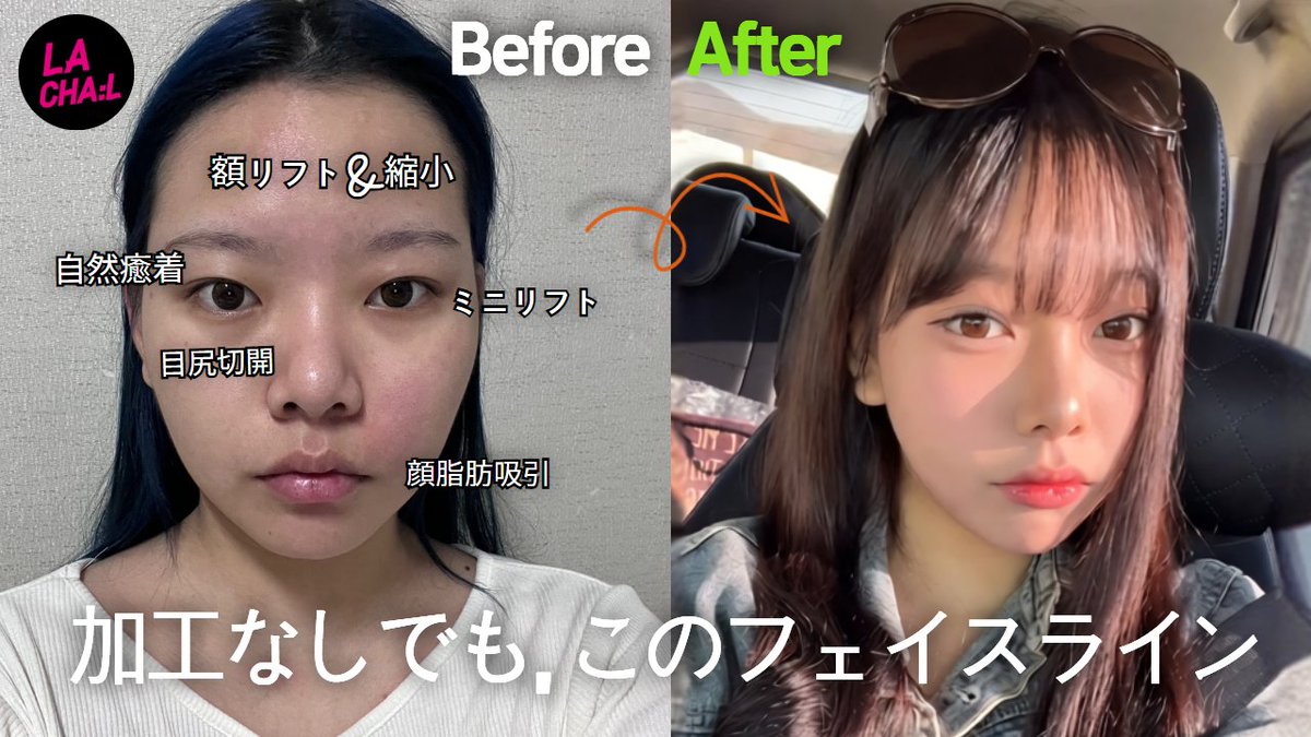 Lachal_JP's tweet photo. 加工なしでも、このフェイスライン！

顔にコンプレックスがあった方がラチェルに来て、自信を取り戻し、とても満足した生活を送っているそうです！

#額リフト&amp;縮小
#自然癒着
#目尻切開
#ミニリフト
#顔脂肪吸引
#韓国整形

申し込みはこちらえ！ 
🔻 🔻 🔻
https://t.co/ge1ugwXO1Z https://t.co/5c3JxrZAEz