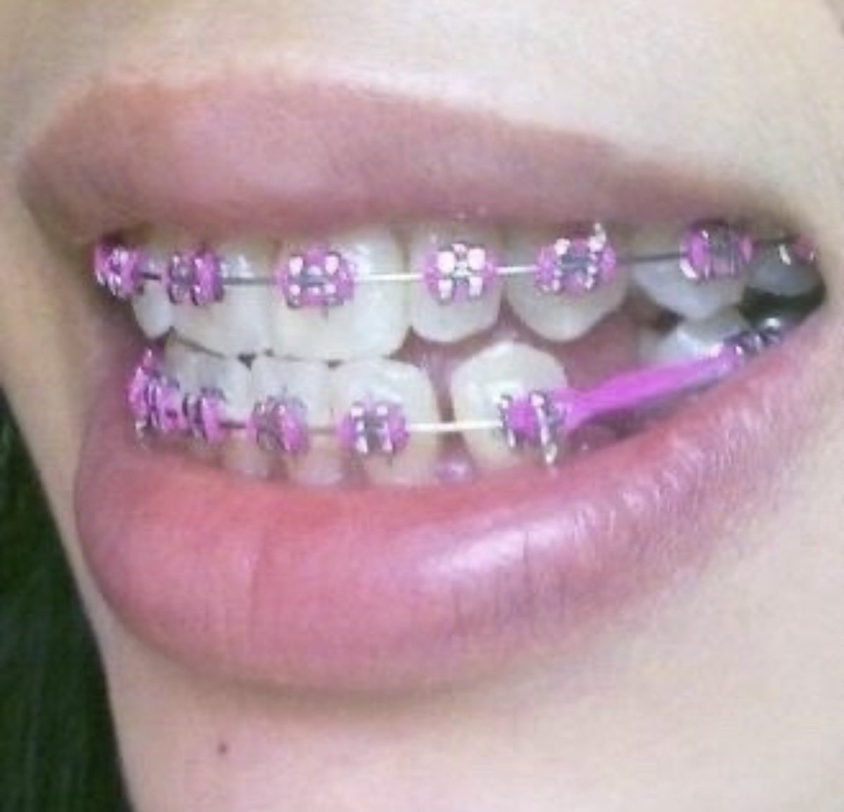forsolaced's tweet photo. Braces are the most attractive thing a girl can have https://t.co/kFrHtjJMMF