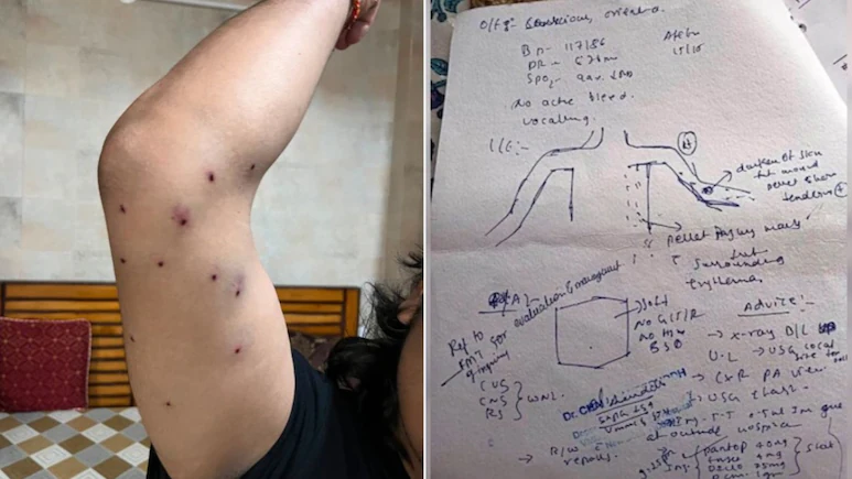 ndtv's tweet photo. "Shards Stuck To Skin": Hospital Report Shows Pellet Guns Used At CJP Protest
https://t.co/cC7yYwF54e https://t.co/n0Gb85LOyW