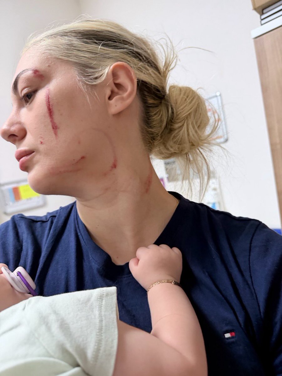 meneymn's tweet photo. Ben Derin Deniz. 2,5 yıldır hamileyken bile eşimden şiddet gördüm. Son olayda bebeğimi kucağımdan zorla aldılar. Eşim beni yatağa fırlatıp defalarca yumrukladı, kaşım patlayınca durdu. Küçük kızımın önünde canıma kastedildi. Ölmek istemiyorum, sesimi duyun! #DerinDenizinSesiyiz https://t.co/6KxUPu3R79