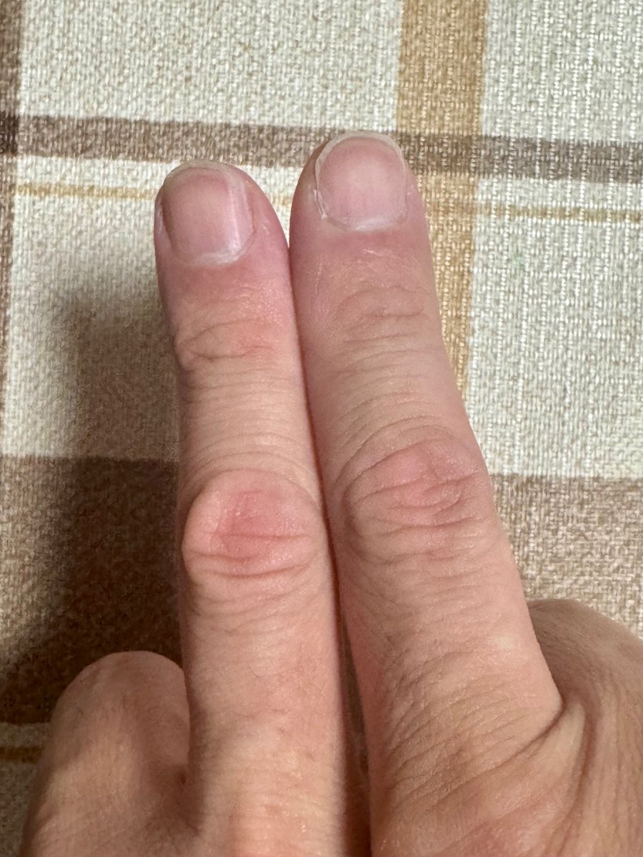 kagami6295's tweet photo. とりあえず、折れてもないし、ヒビも入ってないと言う事で、頑丈な身体に産んでくれた母に感謝しながら、ジム再開しようかと思う。
ただ、箸も痛いし、ペンも痛いのが1ヶ月続くとのこと。
めっちゃダルいわ。 https://t.co/ALTlmgprMp
