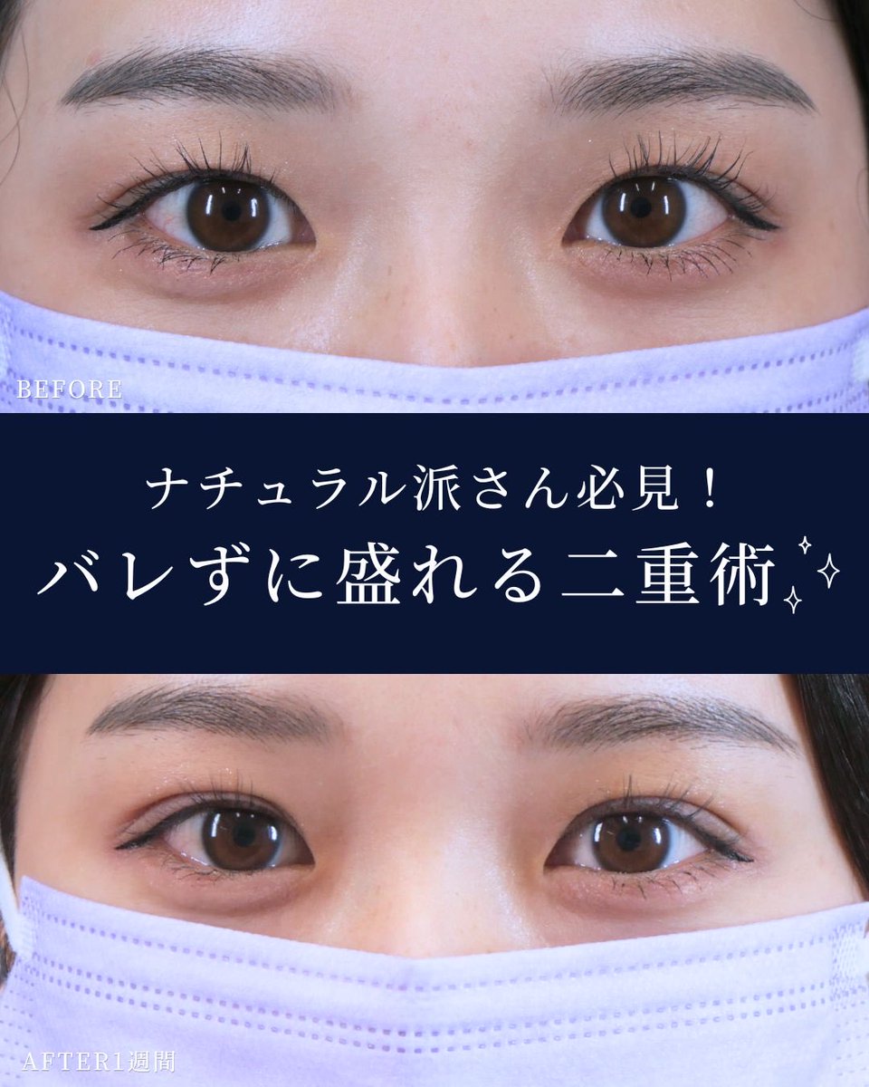 GardenClinicNet's tweet photo. 20代女性：術後1週間💕
施術内容：二重埋没   
注意事項：腫れ、内出血   
●料金：59,400(税込)〜    
↓二重整形の詳細はこちらをチェック 
📷https://t.co/BmicL9g36H https://t.co/kyUOUHhrfs