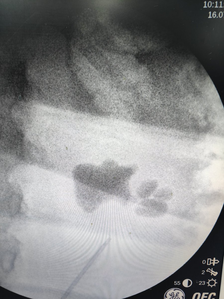 Eslam_wareth's tweet photo. Dose hardness is a matter in pcnl or only on Flexible 🤔
#endourology
#pcnl
#pnl
#stones https://t.co/Q3clcuxkl3