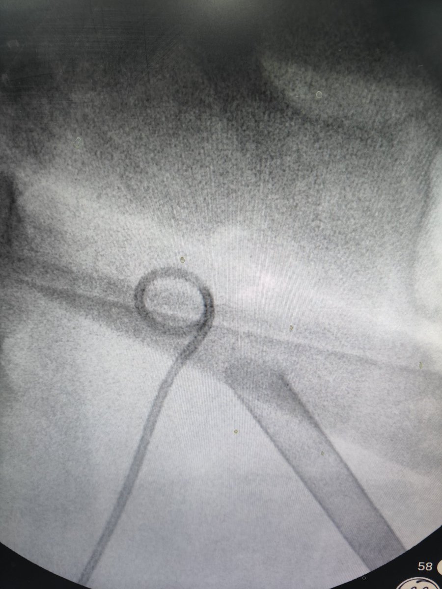 Eslam_wareth's tweet photo. Dose hardness is a matter in pcnl or only on Flexible 🤔
#endourology
#pcnl
#pnl
#stones https://t.co/Q3clcuxkl3