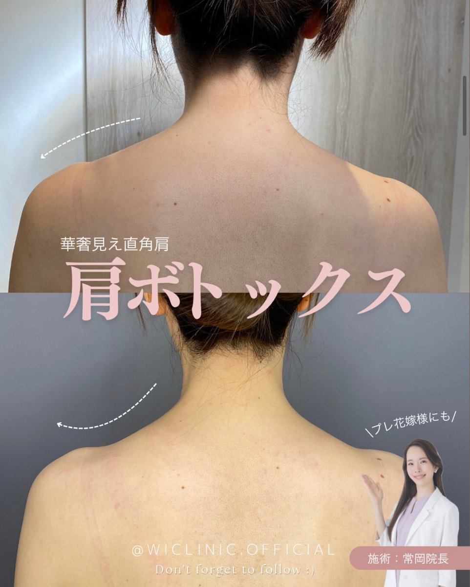wiclinicpr's tweet photo. 7月末まで！⏰

韓国製肩ボトックス
 20％OFFキャンペーン実施中✨

夏の肩見せファッションや
結婚式前のメンテナンスにもおすすめ💎

気になる方はぜひ症例をご覧ください！
キャンペーン終了まであとわずかです🫧

#ウィクリニック #肩ボトックス #プレ花嫁 #美容医療 https://t.co/0unnirjs7z