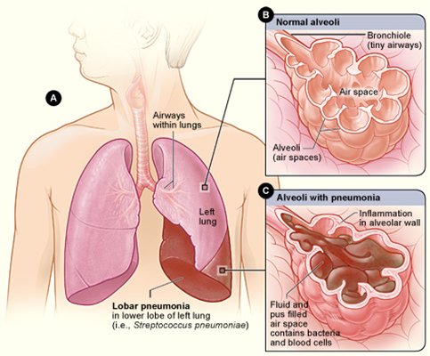 reflectonew's tweet photo. What Is Pneumonia?
➡️https://t.co/bi0Rq0hkhx https://t.co/TbCJNiLGfM