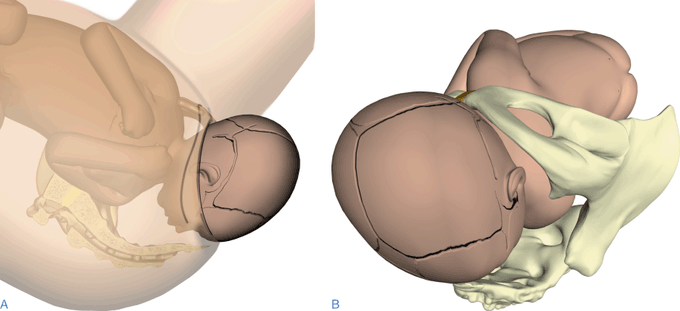 osemagnum's tweet photo. shoulder dystocia

about 50% of labour which have shoulder dystocia (shoulder of the baby being stuck at the vagina) are babies which are of normal size.  

that said,

In shoulder dystocia, the shoulder of the baby is stock during delivery after the head has come out.

This is called Shoulder dystocia. This could be a frightening situation for a young midwife or doctor. Baby must be delivered within 5 minutes!... do not pull the head!

Sadly, some babies succumb and do not make it or some survive but with some great damages already done.  

Good selection of women to try vaginal delivery is essential. 

Pls, when your doctor advises you guys to do C/S, let no Pastor or relative be a weapon fashioned against you!