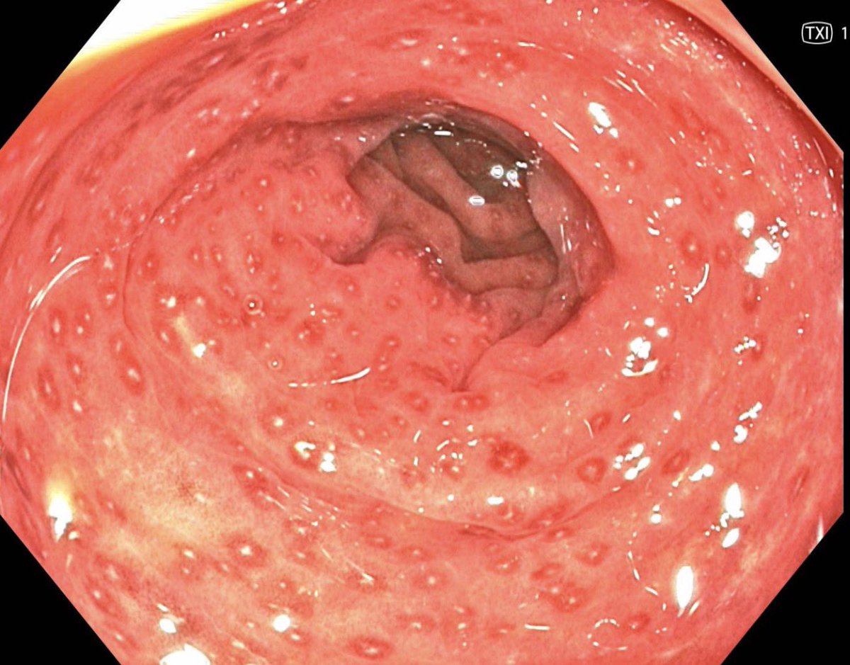 sepdigestiva's tweet photo. #QuizSEPD Hallazgos de la colonoscopia de un paciente de 40 años con un mes de evolución de diarrea y sangrado rectal. ¿Cuál es el diagnóstico? https://t.co/RMtQ32ODY0