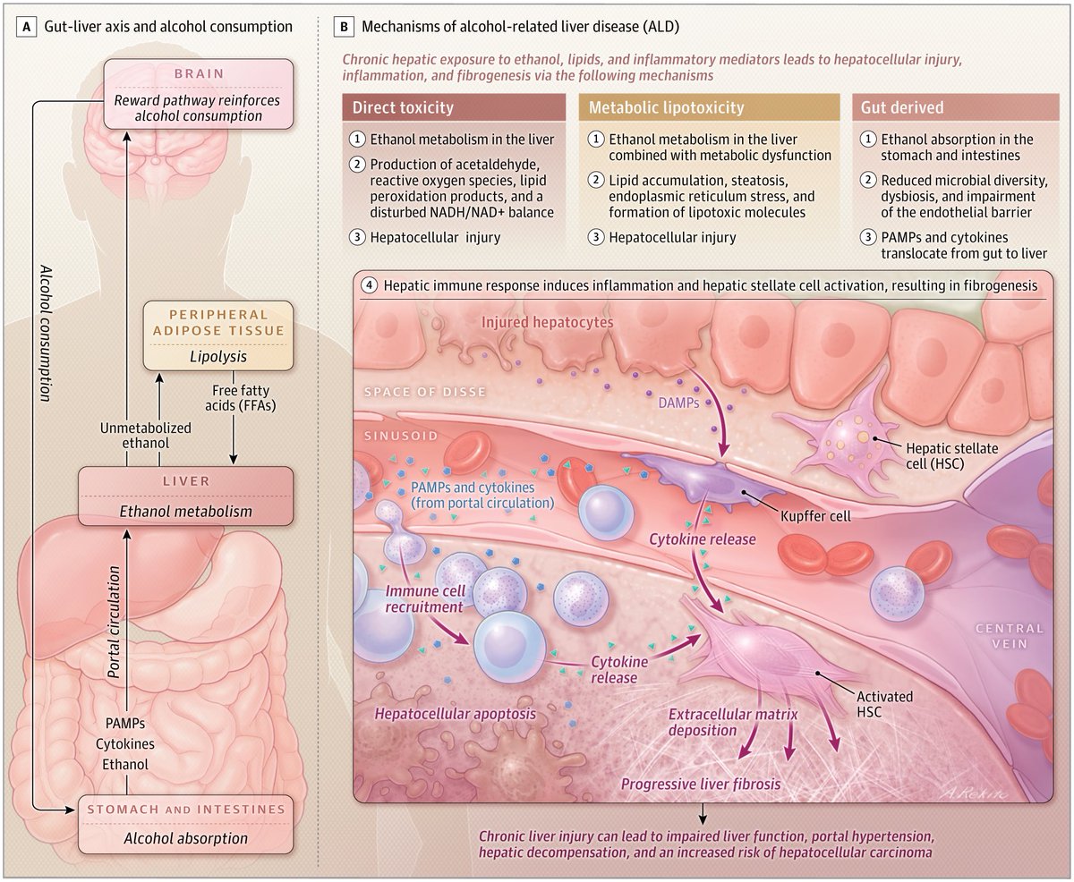 sepdigestiva's tweet photo. Enfermedad hepática relacionada con el alcohol: nueva revisión de JAMA (julio de 2026) 🚨

1️⃣ Fisiopatología ⚙️
2️⃣ Progresión de la enfermedad ➡️
3️⃣ Evaluación clínica 💡
4️⃣ Manejo y tratamiento 💊
📸: https://t.co/lvWNv7RNLk https://t.co/bvky1rcZGS