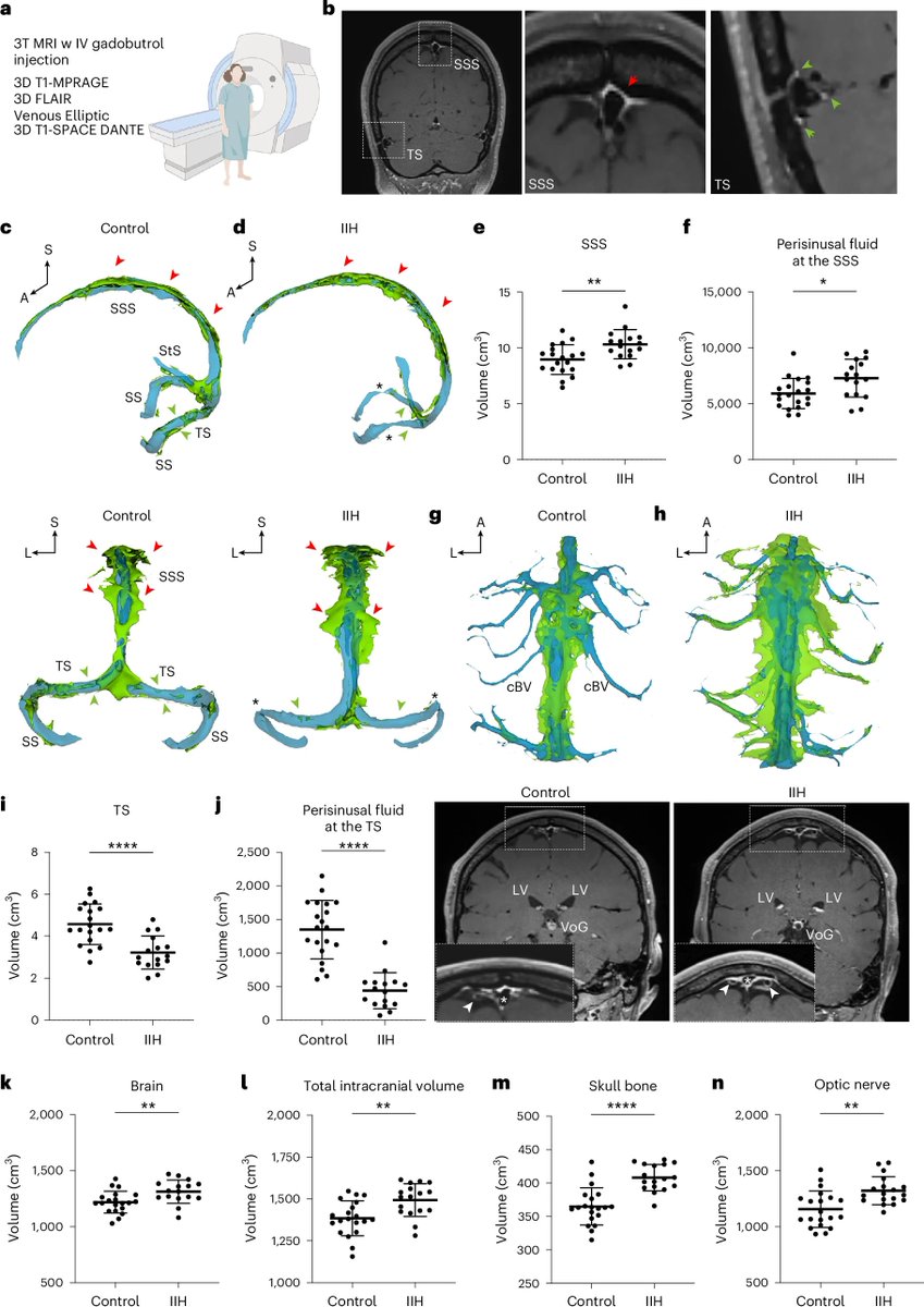 LukensJohnR's tweet photo. Cerebral venous blood flow regulates intracerebral pressure and brain clearance via meningeal lymphatic vessels @NatureNeuro 
https://t.co/gWs9F5rcMn https://t.co/U8X2VLxjbE