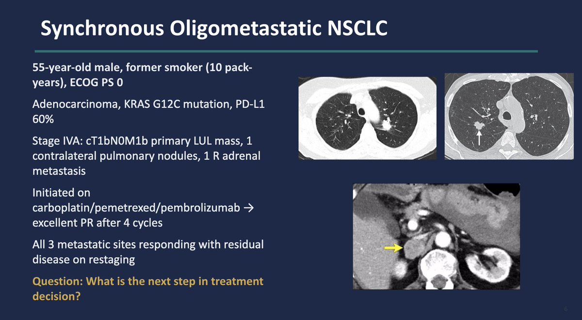 lungoncdoc's tweet photo. Oligometastatic NSCLC - what would be your next step in management? @PercyLeeMD  @OncLive  #BTGLung2026 https://t.co/FnfJ27AH3c