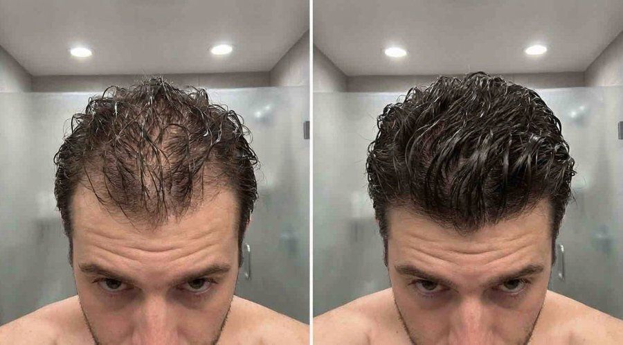 HumanoOcultoX's tweet photo. El 70% de los hombres sufre pérdida de cabello a los 35 años (y no se debe solo a la genética). 
Científicos de Harvard acaban de descubrir una forma de recuperar el cabello. 

Aquí te presentamos 7 métodos científicamente probados para que tu cabello crezca más grueso (y se mantenga negro para siempre):