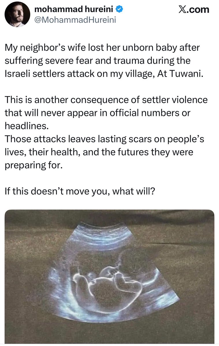 DropSiteNews's tweet photo. ⭕️ UPDATE: A pregnant Palestinian woman has lost her unborn baby after an Israeli settler attack on the village of Al-Tuwani in the occupied West Bank, according to local journalist and activist Mohammad Hureini and journalist Adele Shoko.

More than two dozen masked settlers attacked the village overnight Sunday, setting fire to the Al-Taqwa Mosque, two homes, a women-run dairy factory and a vehicle. Residents said the assault took place in full view of Israeli forces.

Hureini said the woman, his neighbor’s wife, suffered “severe fear and trauma” during the attack before losing her pregnancy. Shoko, who witnessed the assault, said the woman had also been attacked by settlers.