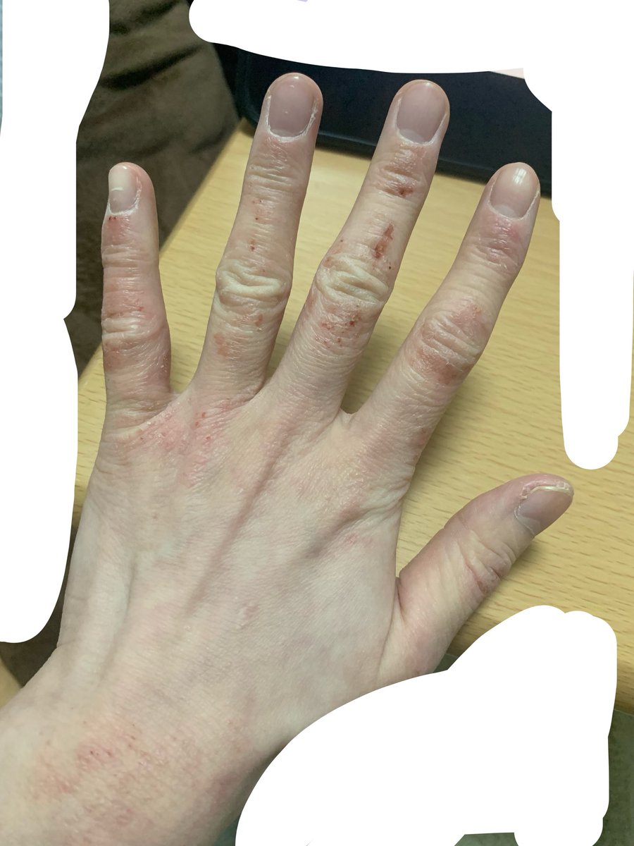 rikai46's tweet photo. 傷の感じが少し変わってきて汁っぽいのが血っぽくなってきた気がする、左はベロンという感じだけど今日のは一部に引っ掻き傷、みたいな https://t.co/pGrEVdGS53