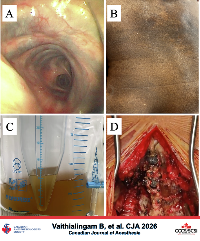 CASUpdate's tweet photo. Tracheal ochronosis - Canadian Journal of Anesthesia 

Access online - https://t.co/VM267MSF2O

@CJA_Journal

#CJA #CJA2026 #Anesthesia #TrachealOchronosis #CanadianAnesthesia #AnesthesiaCare #MedicalResearch #AnesthesiaCommunity https://t.co/VmK6tMllGV