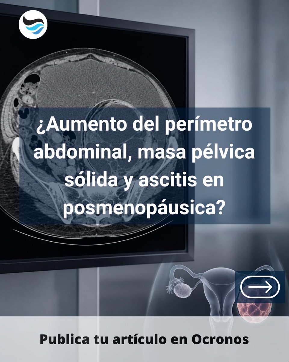 revistaocronos's tweet photo. Cáncer de ovario: alerta tardía  
Masa pélvica sólida, ascitis y posmenopausia orientan sospecha; CA 125 sirve para seguimiento, no cribado poblacional.  
Guárdalo para repasar 🧠 #Ginecología #Medicina https://t.co/Lf6XNIjS3g