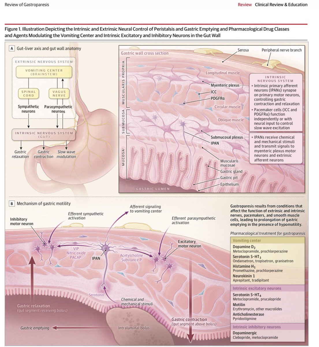 rksanti's tweet photo. 🩺 Gastroparesis (Gastroparesia) – A Review (JAMA 2026)
🫃 La gastroparesia es un trastorno caracterizado por un vaciamiento gástrico retardado en ausencia de obstrucción mecánica, producido por alteraciones de la motilidad antral, disfunción del píloro y compromiso de los nervios entéricos, células intersticiales de Cajal y músculo liso gástrico. 📊 Su prevalencia confirmada en EE. UU. es de 21,5 por cada 100.000 habitantes, predominando en mujeres (relación 2–4:1), y sus principales causas son diabetes mellitus tipo 2 (51,7%), cirugía previa, medicamentos (opioides, agonistas GLP-1, anticolinérgicos y cannabis), diabetes tipo 1 e idiopática. 🤢 Debe sospecharse en pacientes con náuseas crónicas, vómitos, saciedad precoz, plenitud posprandial, distensión abdominal y dolor epigástrico, especialmente si presentan diabetes de larga evolución o antecedentes quirúrgicos. 🔍 El diagnóstico requiere descartar obstrucción mediante endoscopia digestiva alta o tomografía y confirmar el retraso del vaciamiento con gammagrafía de vaciamiento gástrico de 4 horas (estándar de oro) o la prueba respiratoria con espirulina marcada con carbono-13, clasificándose como leve (10–15%), moderada (16–35%) o grave (>35% de retención a las 4 horas). 🥗 El tratamiento inicia con la suspensión de fármacos que retrasan el vaciamiento, optimización del control glucémico, dieta de partículas pequeñas, baja en grasa y fibra, comidas pequeñas y frecuentes e hidratación adecuada; los antieméticos (ondansetrón, prometazina) alivian síntomas leves, mientras que los procinéticos como metoclopramida (único aprobado por la FDA, uso ≤12 semanas por riesgo de discinesia tardía) y eritromicina son el tratamiento farmacológico de elección en enfermedad moderada. 🚑 En casos refractarios pueden requerirse nutrición enteral yeyunal, miotomía endoscópica peroral gástrica (G-POEM) o estimulación eléctrica gástrica, procedimientos que han demostrado mejorar significativamente los síntomas y la calidad de vida en pacientes seleccionados.
📚 Camilleri M. Gastroparesis: A Review. JAMA. Published online July 22, 2026. doi:10.1001/jama.2026.12181. Gastroparesis JAMA 2026
✅ https://t.co/NgkvEKsFxN