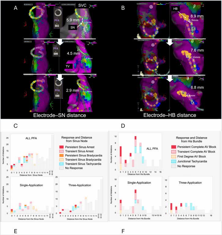 CirculationEP's tweet photo. In swine, PFA near the sinus node and His bundle caused distance-dependent conduction injury #Epeeps @iwanari65284818 @TAMA07120380
https://t.co/N8DscCa0Pd https://t.co/kWmg266rHQ