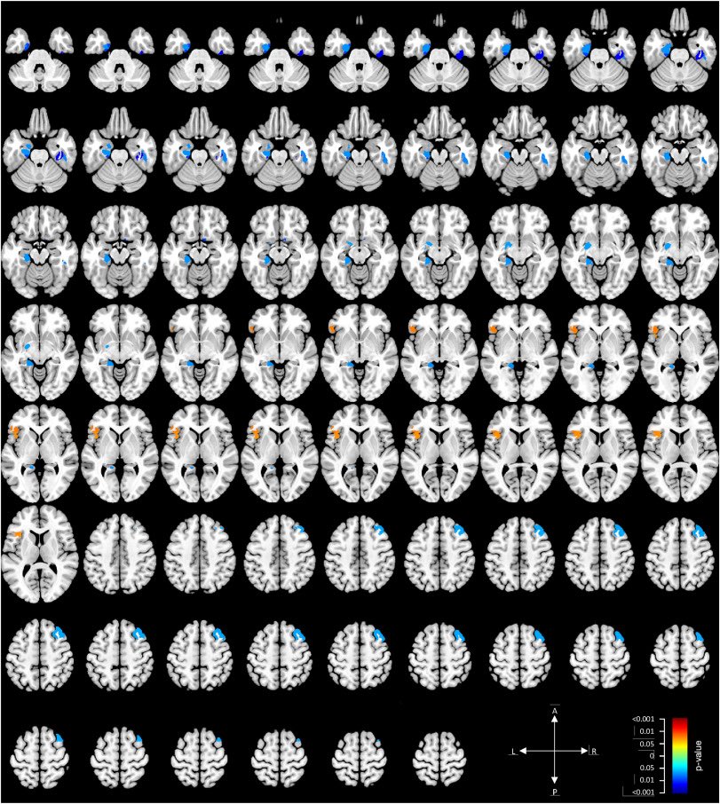 ParkinsonismD's tweet photo. Region-based morphometry in Parkinson's disease patients with GBA mutation and its predictive role for cognition after STN-DBS
#deepbrainstimulation #DBS #GBA #PD #morphometry #VBA #STN #cognition #subthalamic #RBM
PRD Vol 148 Jul 2026
@PRDAssociation
https://t.co/M1Y9kI1OMr https://t.co/6tZO7sZ2iG