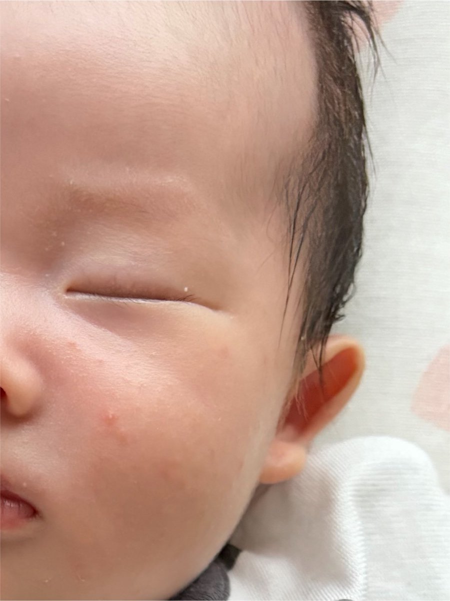 ruu__2102's tweet photo. 3日目前まで酷かった
乳児湿疹が健診の時に出してもらった薬で一気に綺麗になった😍
出してもらった薬私も同じの持ってた😂
女の子だし私がアトピー持ちだから凄い気にしちゃう🥺 https://t.co/hd6Fm7NRXy