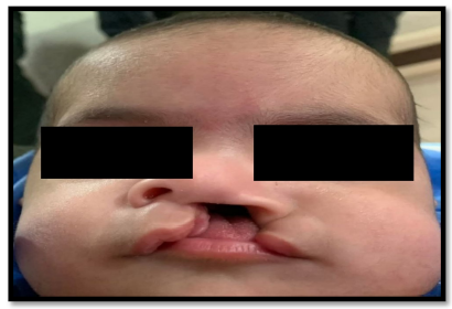 sciinterna's tweet photo. New in AJBS: PCR detected the mecA gene in S. aureus from cleft lip and palate patients, supporting accurate MRSA detection and improved infection management.

📖 https://t.co/GpoA1JZckc

#MRSA #PCR #AntibioticResistance #CleftLip #AJBS https://t.co/d3tqGiQytV